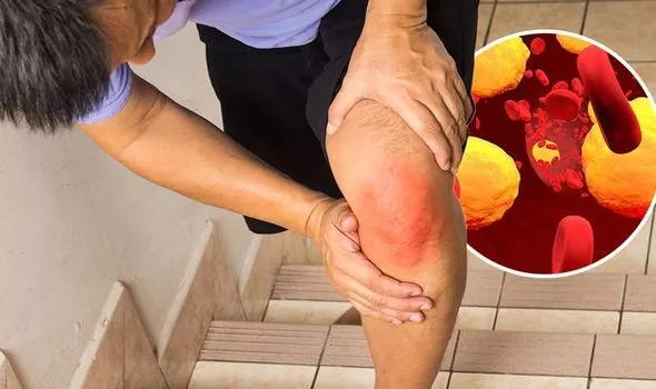 علامات ارتفاع نسبة الكوليسترول