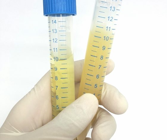 البول الاصفر