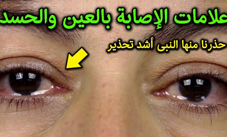 حذرنا منها النبي ﷺ .. ظهور هذه العلامات تدل على أنك مصاب بالعين والحسد وانك فى خطر كبير..انتبه وتعرف عليها فوراً
