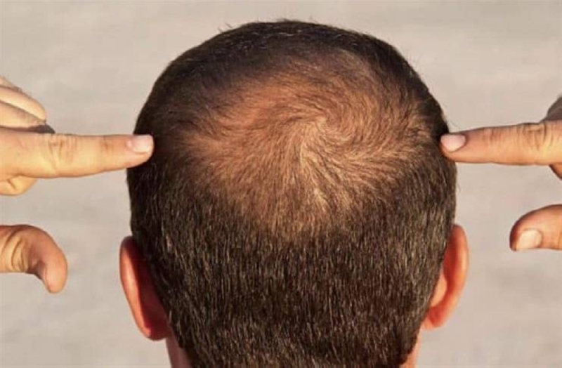 دراسة حديثة تكشف عن علامة بأصابع الرجال تدل على إصابتهم بالصلع..شاهد 