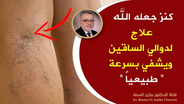 علاج معجزة لدوالي الساقين ويشفي بسرعة فائقة بدون أدوية وأطباء 