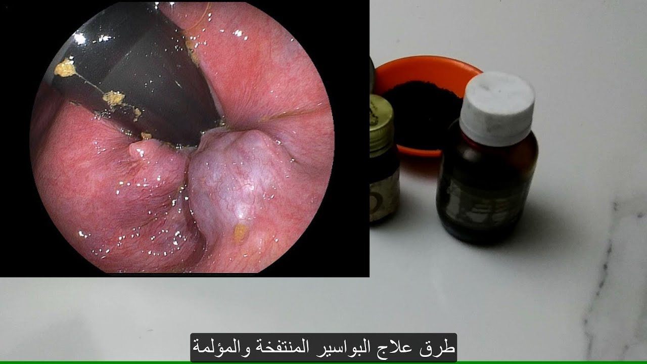 لاداعي للقلق و التفكير بالجراحة والإحراج .. علاج البواسير بشكل نهائي وانت في منزلك بطريقة بسيطة وبدون أدوية واطباء !