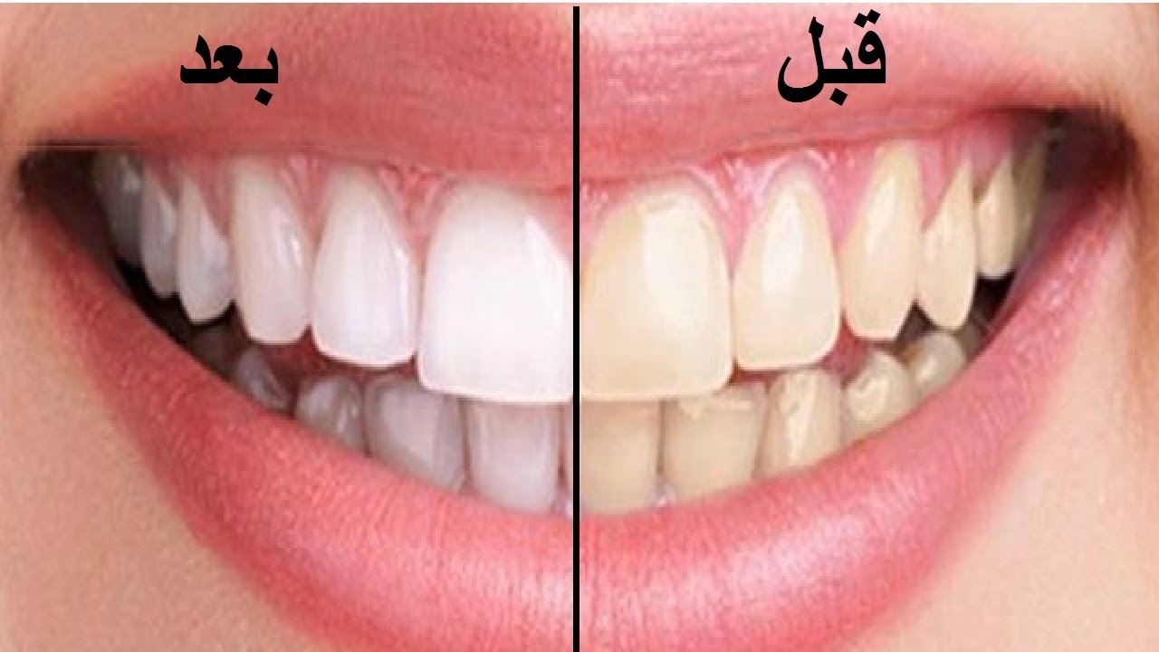تبييض الاسنان