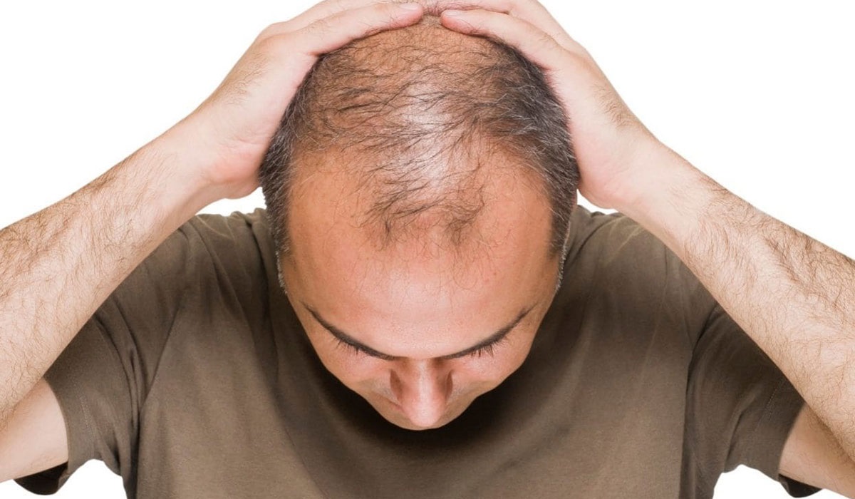 مفاجأة غير متوقعة عن الرجل الأصلع .. دراسة علمية حديثة تكشف النتيجة التي توصلت إليها ؟