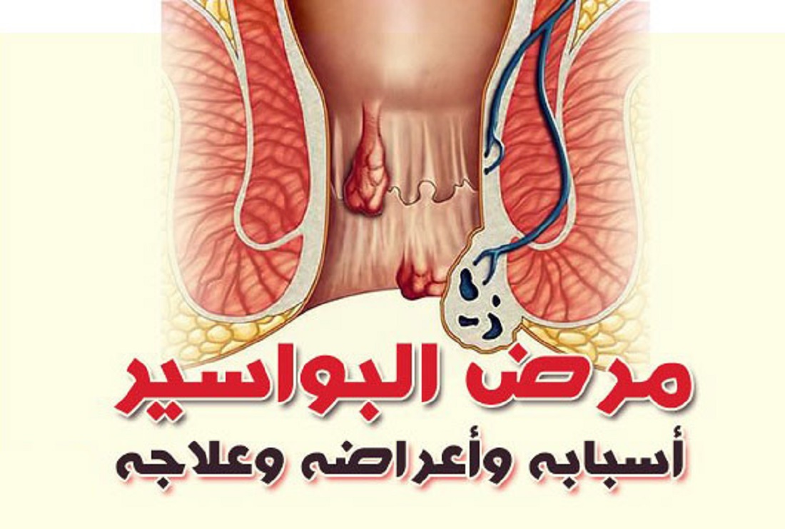 مرض البواسير