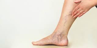 اقوى علاج فعال للتخلص من الدوالي بسهوله بطريقه امنه وطبيعيه لن تستغني عنها من اليوم