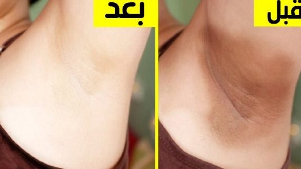 وداعا لسواد السنين..  كريم طبيعي لتبييض المناطق الحساسة شديدة السواد بياض ملفت من أول استعمال!